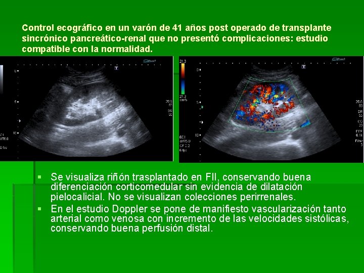 Control ecográfico en un varón de 41 años post operado de transplante sincrónico pancreático-renal