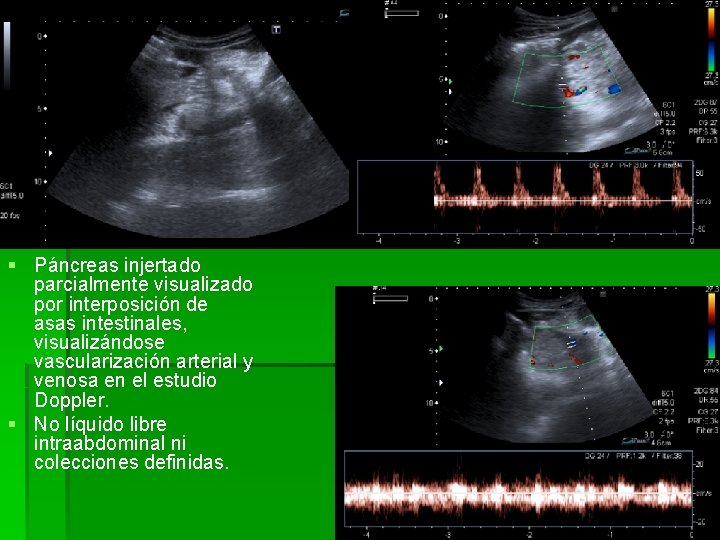 § Páncreas injertado parcialmente visualizado por interposición de asas intestinales, visualizándose vascularización arterial y