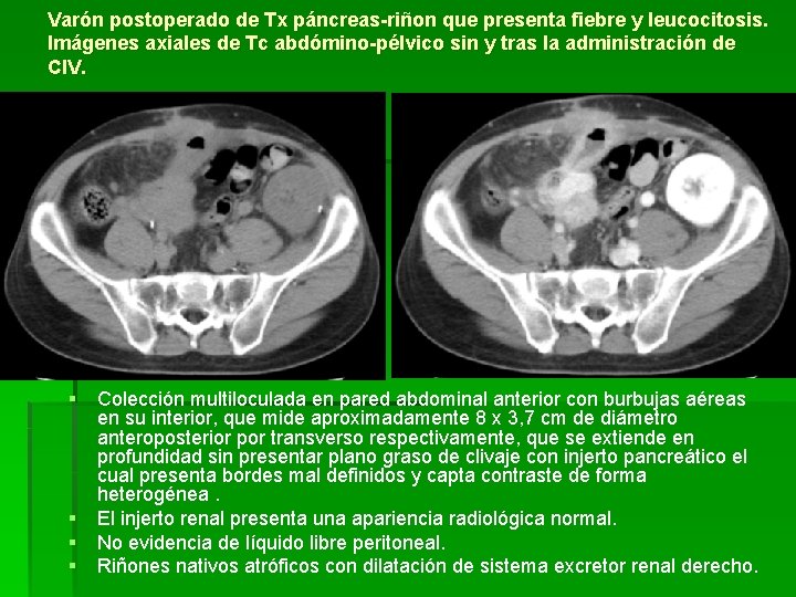 Varón postoperado de Tx páncreas-riñon que presenta fiebre y leucocitosis. Imágenes axiales de Tc