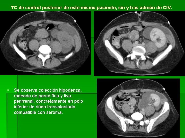 TC de control posterior de este mismo paciente, sin y tras admón de CIV.