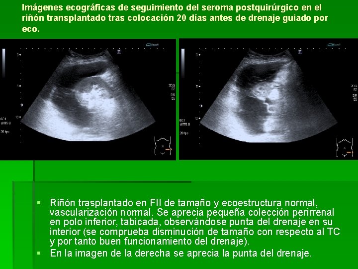 Imágenes ecográficas de seguimiento del seroma postquirúrgico en el riñón transplantado tras colocación 20