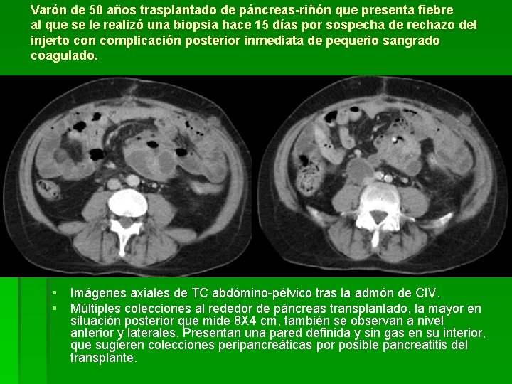 Varón de 50 años trasplantado de páncreas-riñón que presenta fiebre al que se le Varón de 50 años trasplantado de páncreas-riñón que presenta fiebre al que se le