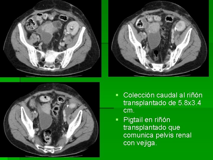 § Colección caudal al riñón transplantado de 5. 8 x 3. 4 cm. §