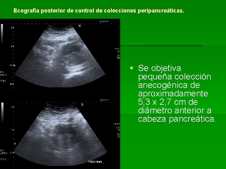 Ecografía posterior de control de colecciones peripancreáticas. § Se objetiva pequeña colección anecogénica de