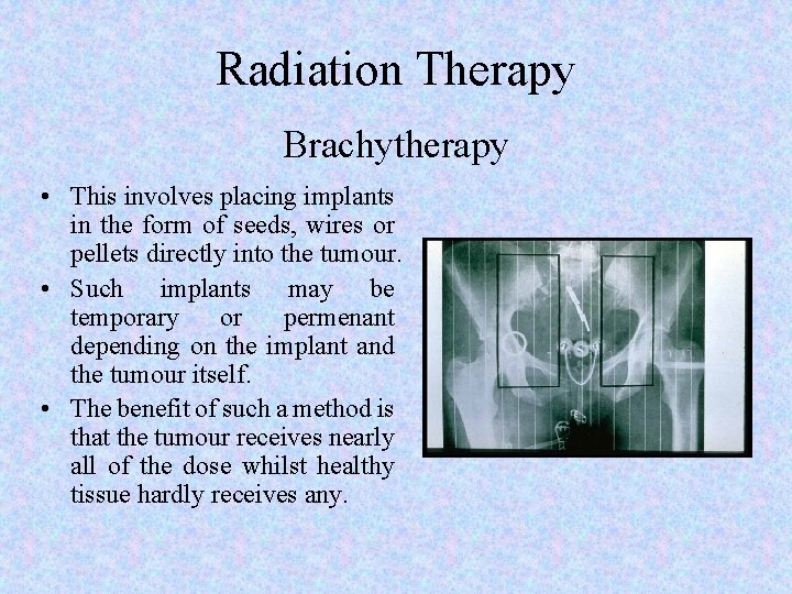 Radiation Therapy Brachytherapy • This involves placing implants in the form of seeds, wires