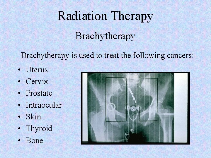 Radiation Therapy Brachytherapy is used to treat the following cancers: • • Uterus Cervix