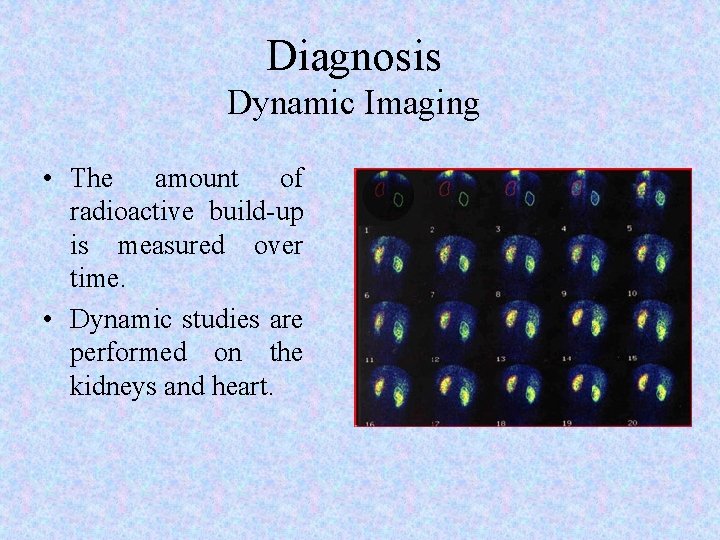 Diagnosis Dynamic Imaging • The amount of radioactive build-up is measured over time. •