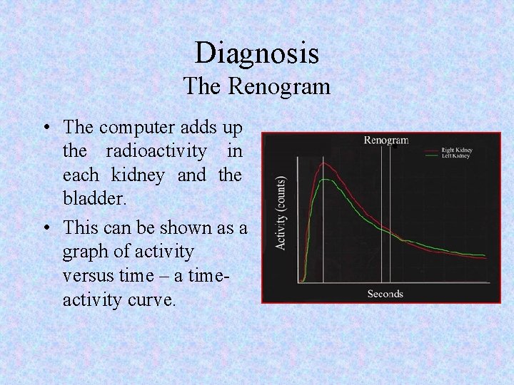 Diagnosis The Renogram • The computer adds up the radioactivity in each kidney and