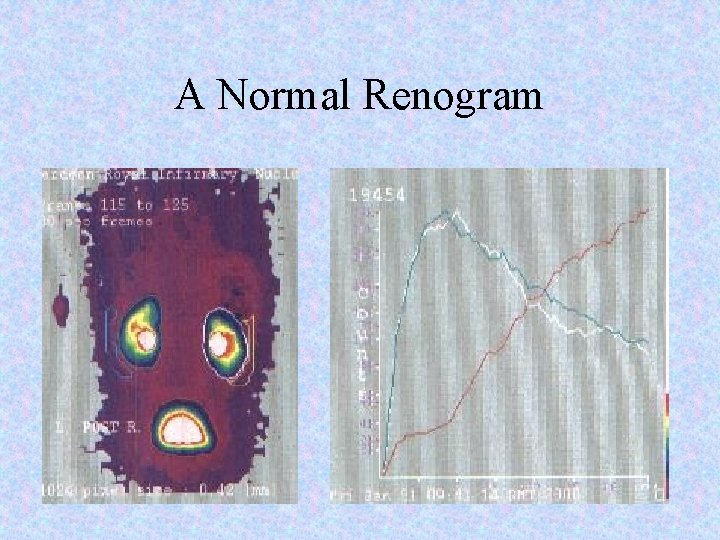 A Normal Renogram 