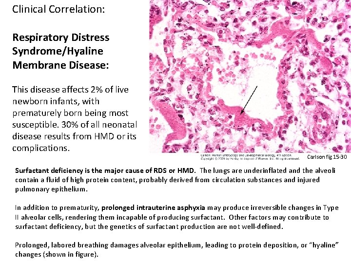 Clinical Correlation: Respiratory Distress Syndrome/Hyaline Membrane Disease: This disease affects 2% of live newborn