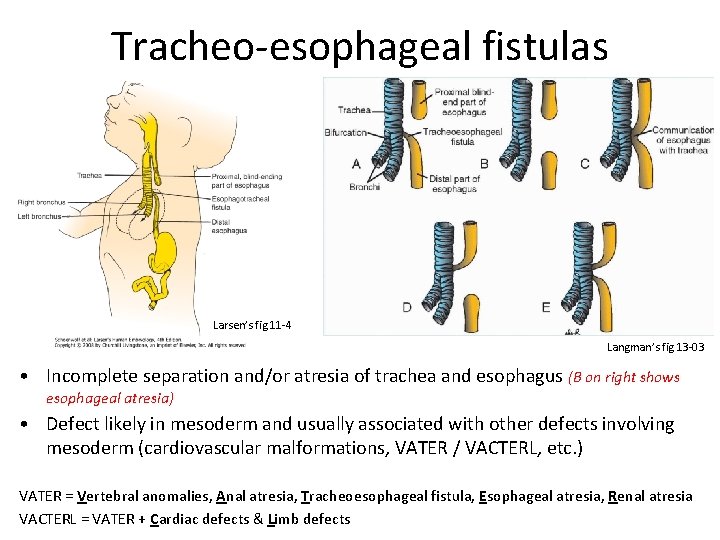 Tracheo-esophageal fistulas Larsen’s fig 11 -4 Langman’s fig 13 -03 • Incomplete separation and/or