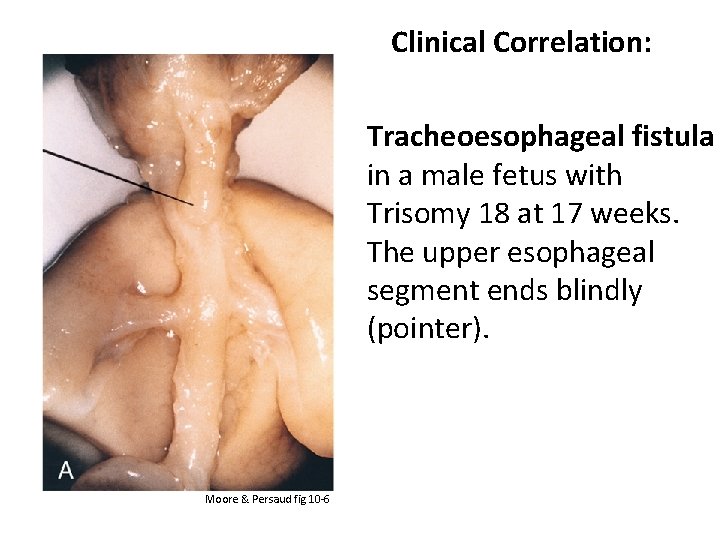 Clinical Correlation: Tracheoesophageal fistula in a male fetus with Trisomy 18 at 17 weeks.