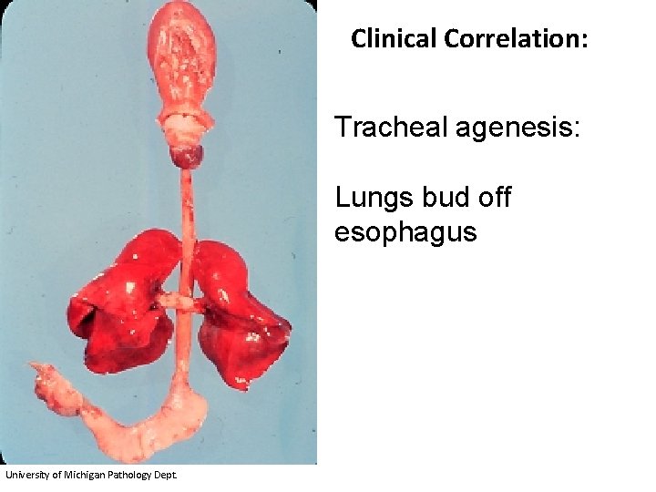 Clinical Correlation: Tracheal agenesis: Lungs bud off esophagus University of Michigan Pathology Dept. 