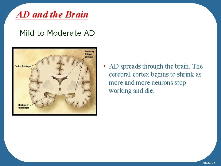 AD and the Brain Mild to Moderate AD • AD spreads through the brain.
