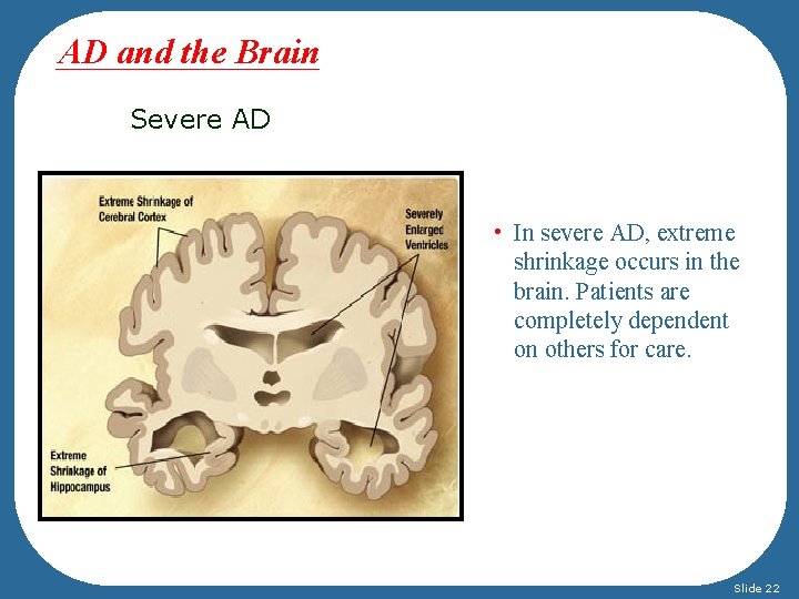 AD and the Brain Severe AD • In severe AD, extreme shrinkage occurs in