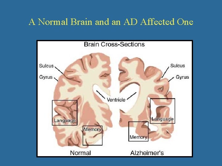 A Normal Brain and an AD Affected One 