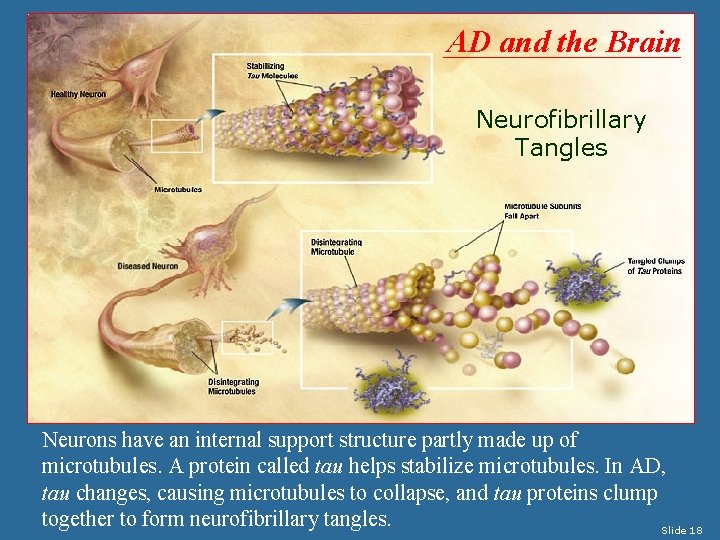 AD and the Brain Neurofibrillary Tangles Neurons have an internal support structure partly made