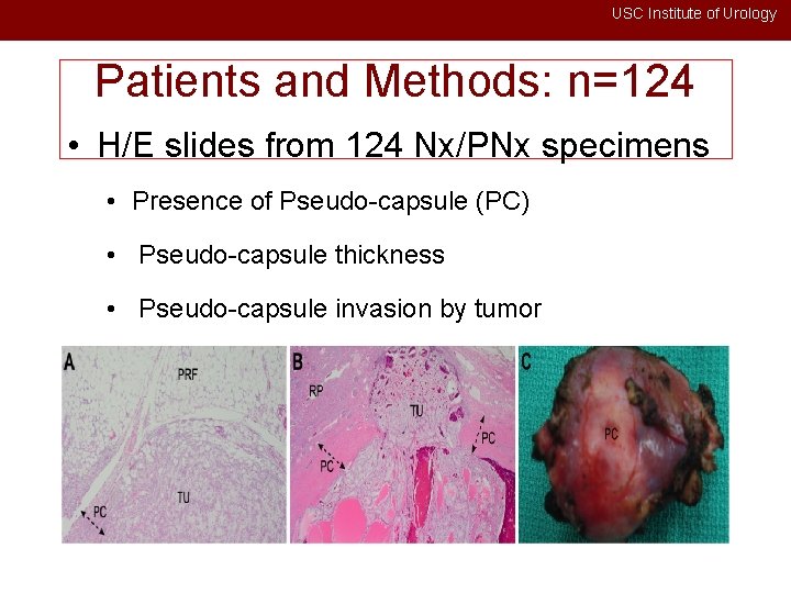 USC Institute of Urology Patients and Methods: n=124 • H/E slides from 124 Nx/PNx