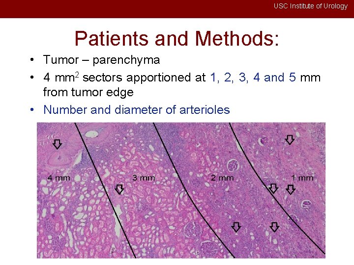 USC Institute of Urology Patients and Methods: • Tumor – parenchyma • 4 mm