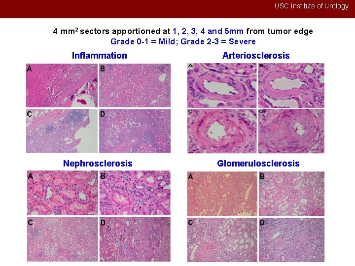 USC Institute of Urology 4 mm 2 sectors apportioned at 1, 2, 3, 4