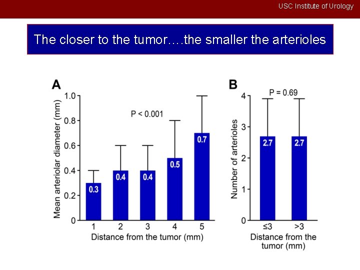 USC Institute of Urology The closer to the tumor…. the smaller the arterioles 