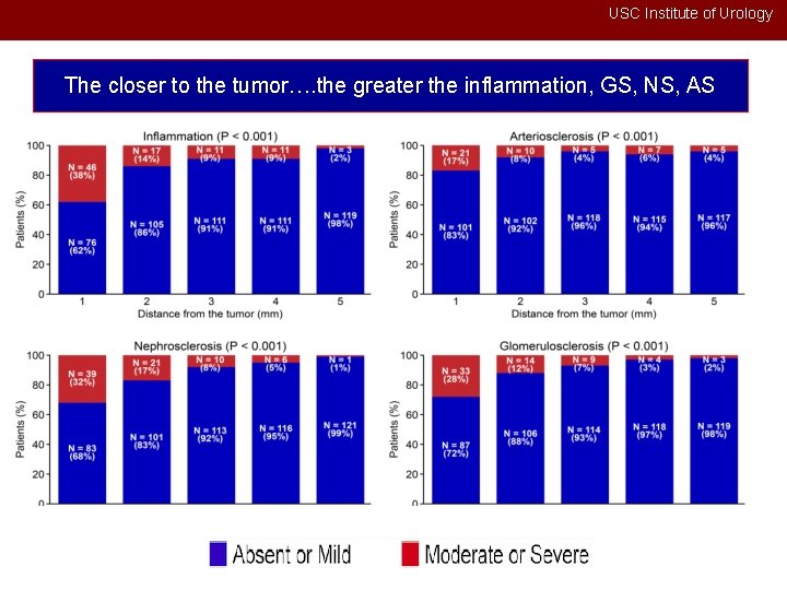 USC Institute of Urology The closer to the tumor…. the greater the inflammation, GS,
