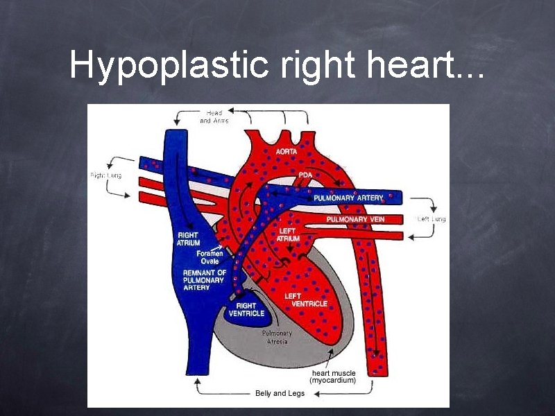 Hypoplastic right heart. . . Hypoplastic right heart. . .