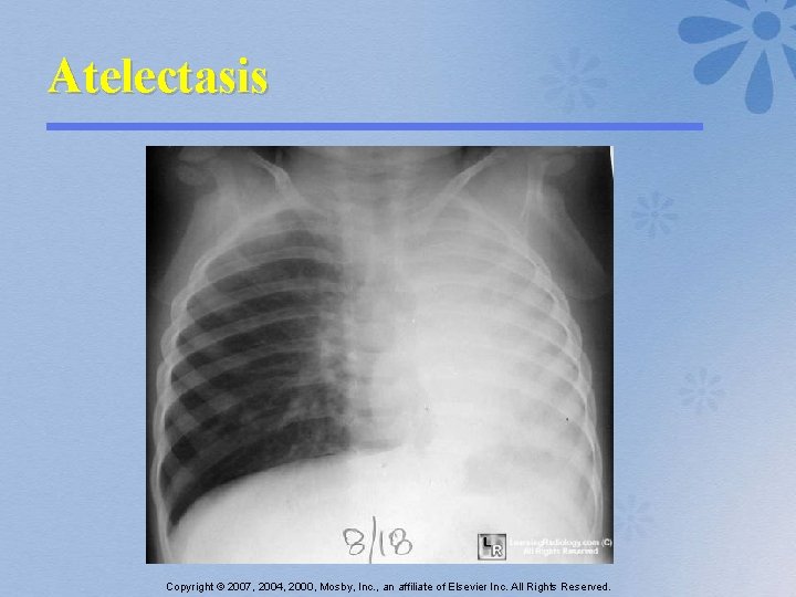 Atelectasis Copyright © 2007, 2004, 2000, Mosby, Inc. , an affiliate of Elsevier Inc.