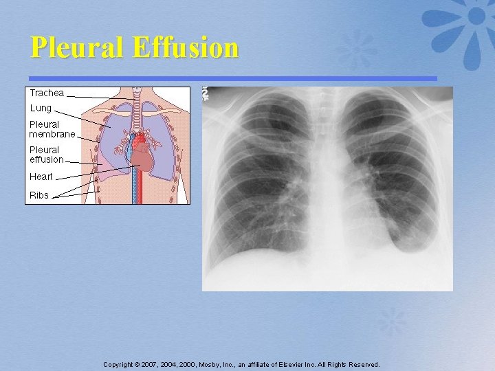 Pleural Effusion Copyright © 2007, 2004, 2000, Mosby, Inc. , an affiliate of Elsevier