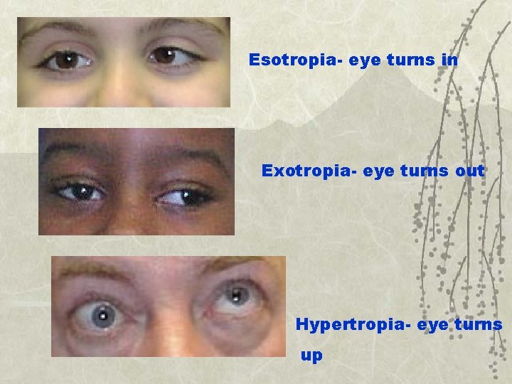 Esotropia- eye turns in Exotropia- eye turns out Hypertropia- eye turns up 