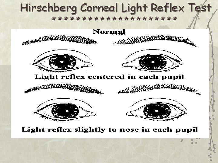 Hirschberg Corneal Light Reflex Test *********** 