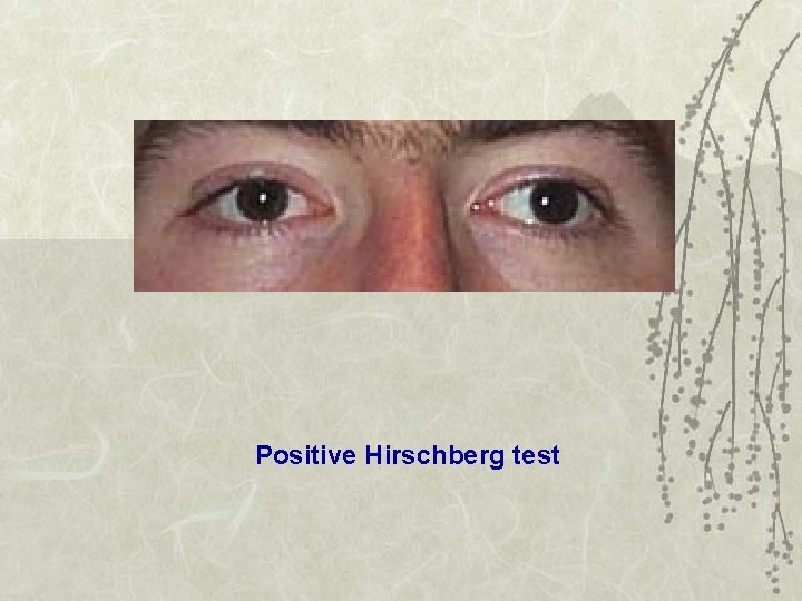 Positive Hirschberg test 