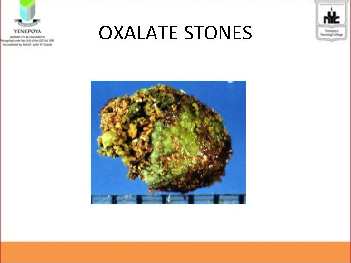 OXALATE STONES OXALATE STONES