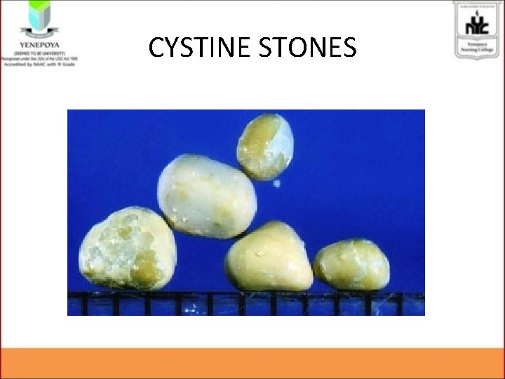 CYSTINE STONES CYSTINE STONES
