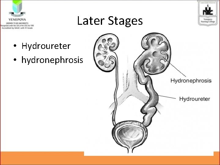 Later Stages • Hydroureter • hydronephrosis Later Stages • Hydroureter • hydronephrosis
