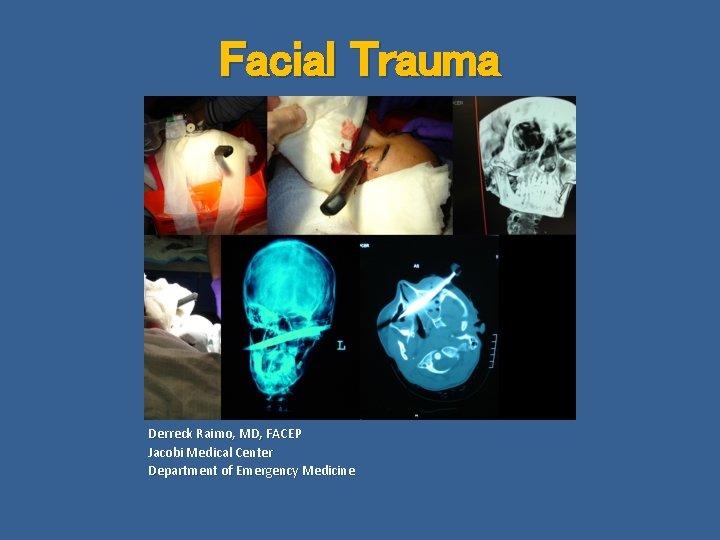 Facial Trauma Derreck Raimo, MD, FACEP Jacobi Medical Center Department of Emergency Medicine 