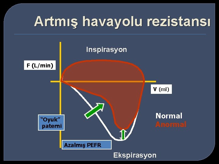 Artmış havayolu rezistansı Inspirasyon F (L/min) V (ml) Normal Anormal “Oyuk” paterni Azalmış PEFR