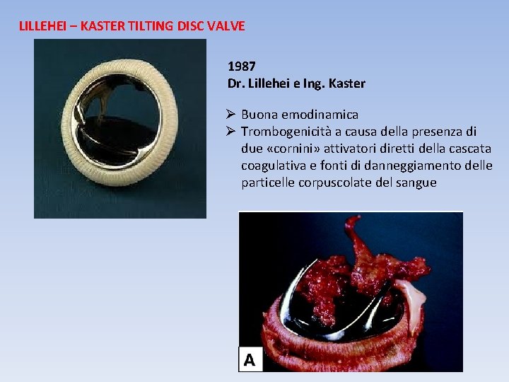 LILLEHEI – KASTER TILTING DISC VALVE 1987 Dr. Lillehei e Ing. Kaster Ø Buona