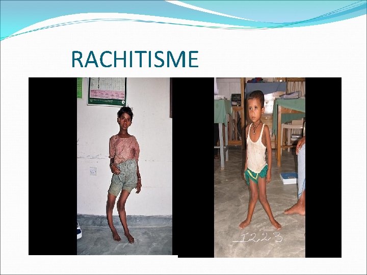 RACHITISME 