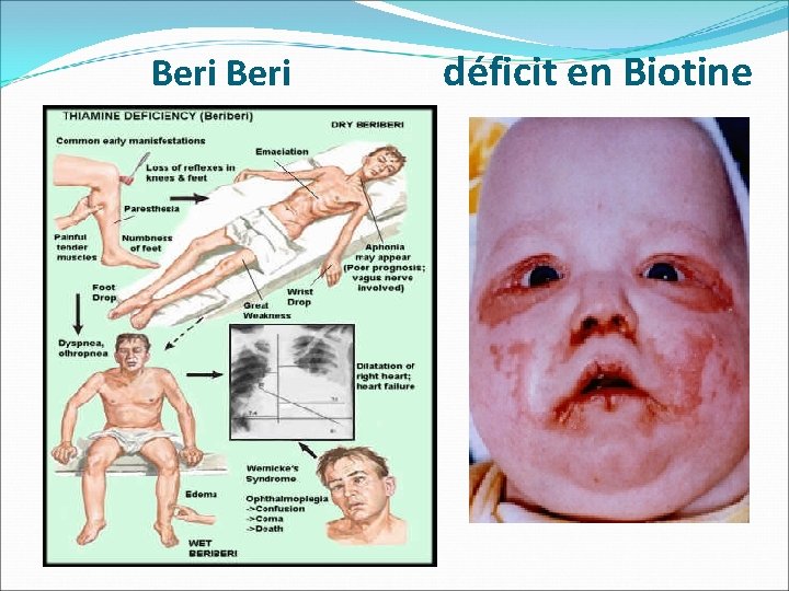 Beri déficit en Biotine 
