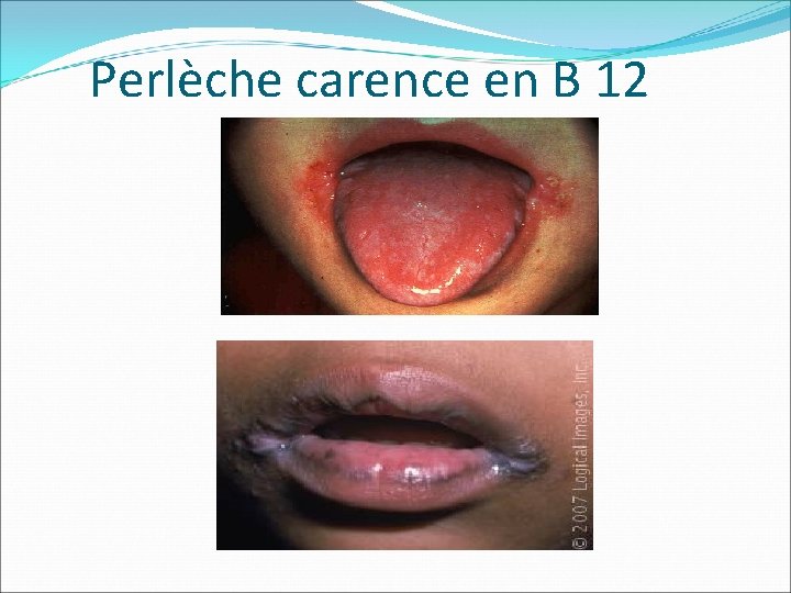 Perlèche carence en B 12 