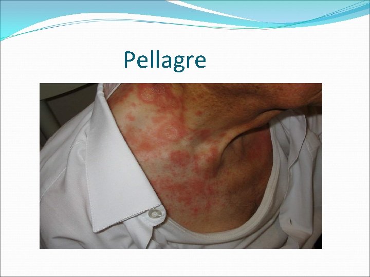 Pellagre 