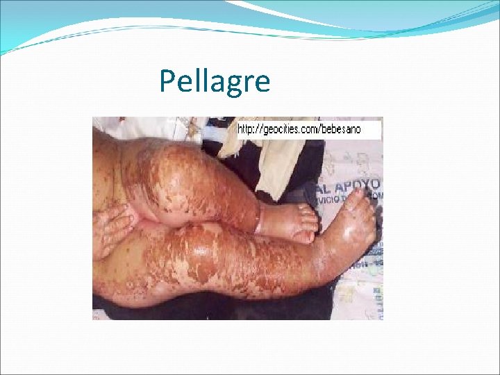 Pellagre 