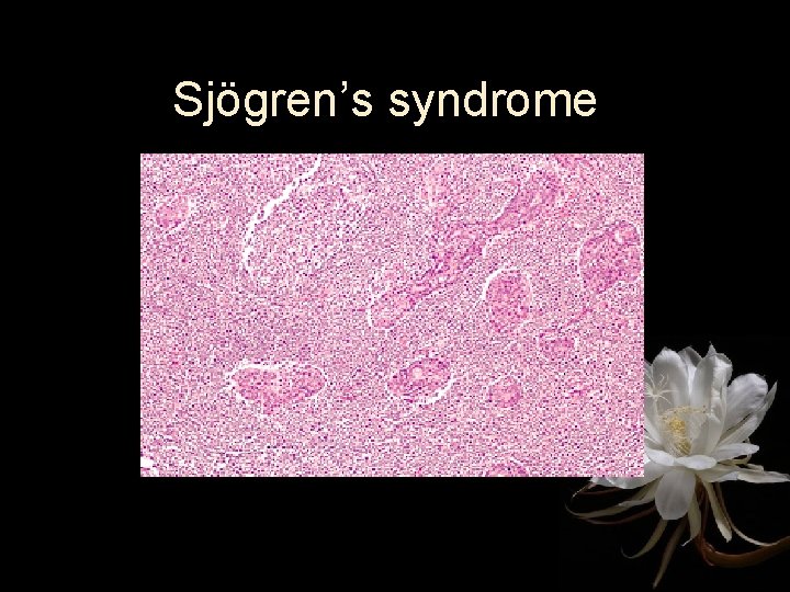 Sjögren’s syndrome 