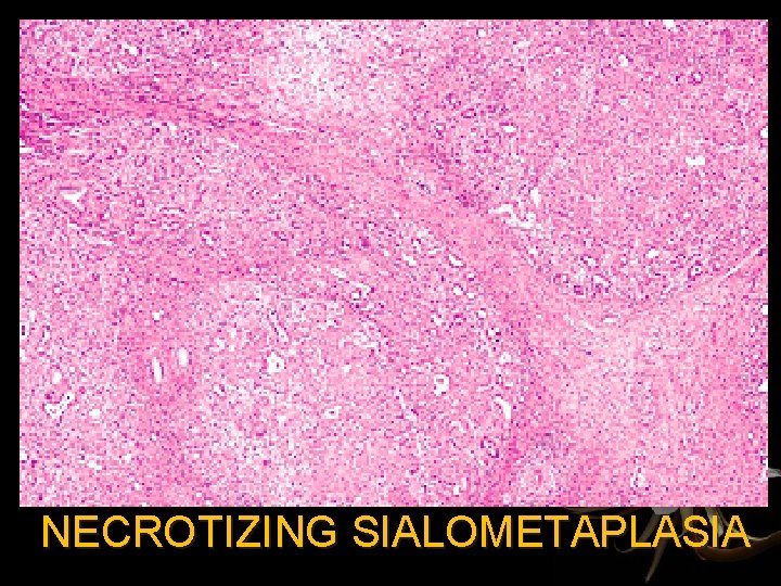 NECROTIZING SIALOMETAPLASIA 