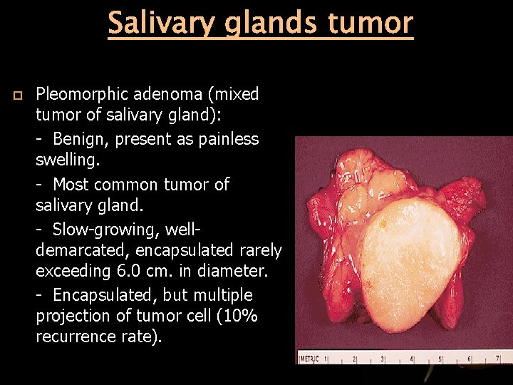 Salivary glands tumor Pleomorphic adenoma (mixed tumor of salivary gland): - Benign, present as