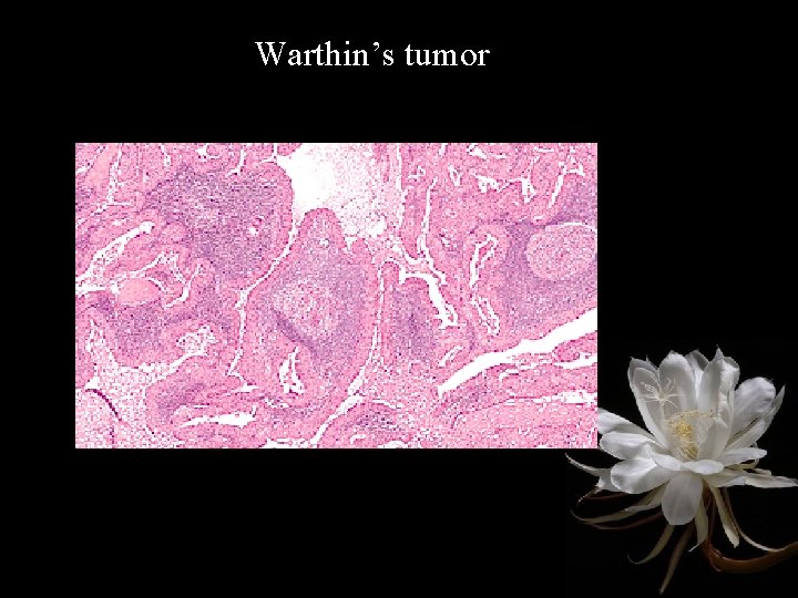 Warthin’s tumor 