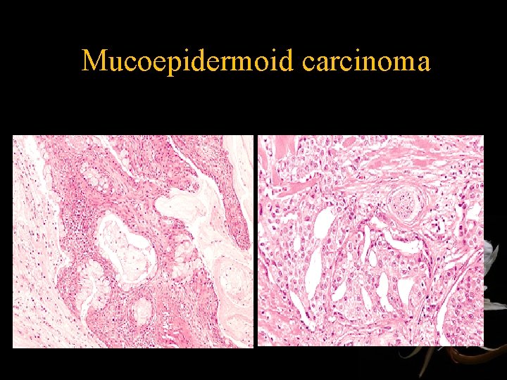 Mucoepidermoid carcinoma • Squamous and glandular component • Most common malignancy of major and