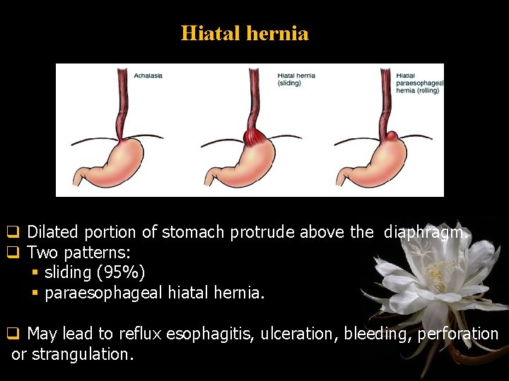 Hiatal hernia q Dilated portion of stomach protrude above the diaphragm. q Two patterns: