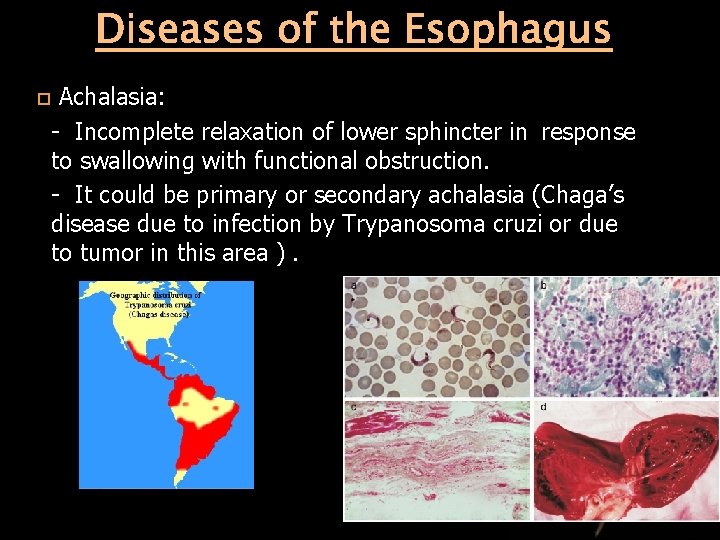 Diseases of the Esophagus Achalasia: - Incomplete relaxation of lower sphincter in response to